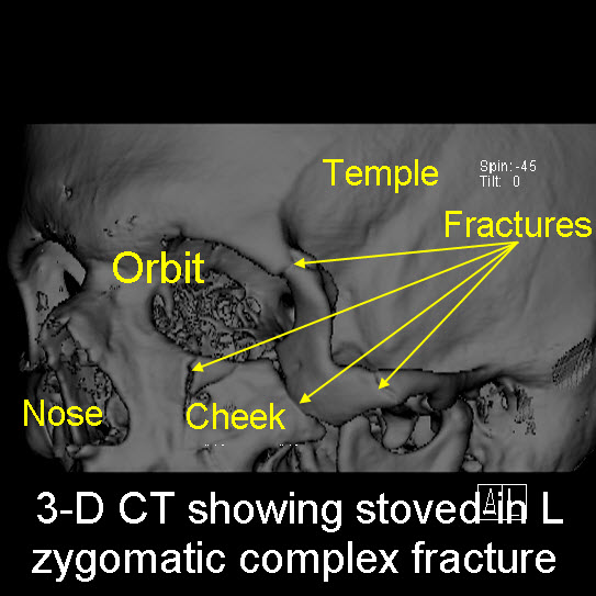 Facial Trauma3